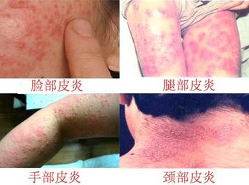 神经性皮炎的症状有哪些